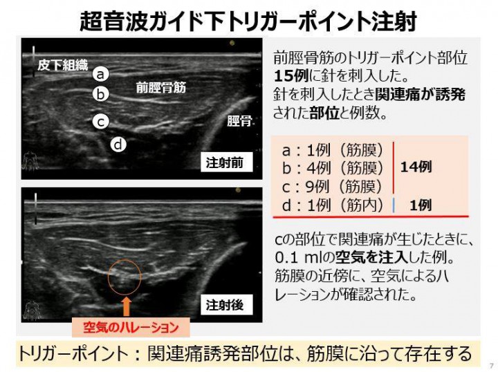参照:小林只 他「筋筋膜性疼痛症候群の病態と形態学的特徴 エラストグラフィー超音波診断装置による検討 第119回日本解剖学会総会・全国学術集会(2014年3月28日)